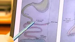 transplanturi de operare unice ale intestinului subțire se face în România