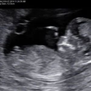 1 trimeszterében ultrahang dekódolást, mértéke ultrahang terhesség korai szakaszában, az első ultrahang