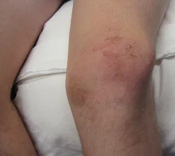 contuzie a efectelor articulația genunchiului de tratament de atac folk la domiciliu