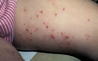 dermatita Venoase pe picioare - simptome și tratament (foto)