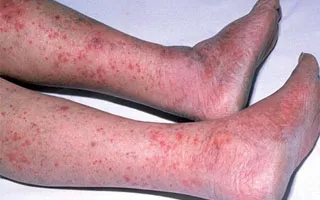 A vénás dermatitis a lábon - tünetek és kezelés (fotó)