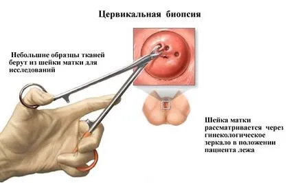 Разпределение на шийката на матката ерозия и други симптоми