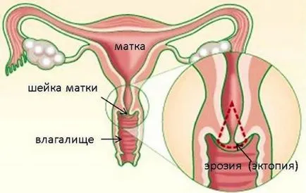 Разпределение на шийката на матката ерозия и други симптоми