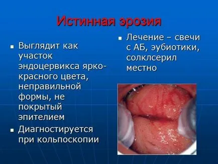 Разпределение на шийката на матката ерозия и други симптоми