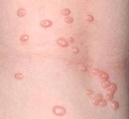 A vírusos fertőzések, a bőr