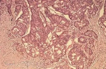 Igen differenciált adenocarcinoma a gyomor