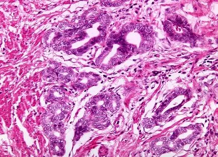 Igen differenciált adenocarcinoma a gyomor