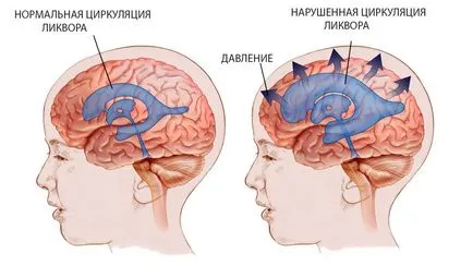 hipertensiune intracraniană la copii, adulti, cauze, simptome, tratament, remedii populare