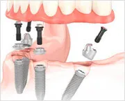 Jellemzők biohorizons implantátumok betegek