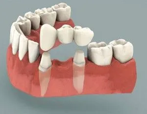 dinți falși care dinții mai bine decât din plastic sau ceramică
