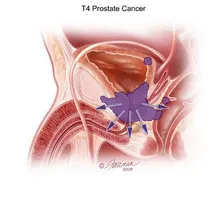 Tratamentul chirurgical al tipurilor de operațiuni prostatita, performanță și gama de echipamente de agrement