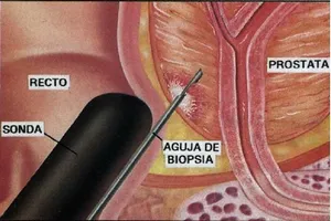 Tratamentul chirurgical al tipurilor de operațiuni prostatita, performanță și gama de echipamente de agrement