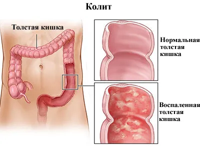 Tratamentul cronic colita spastică - moda frumos