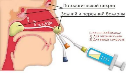 YAMIK-eljárás sinusitis, sinus lavage katéter