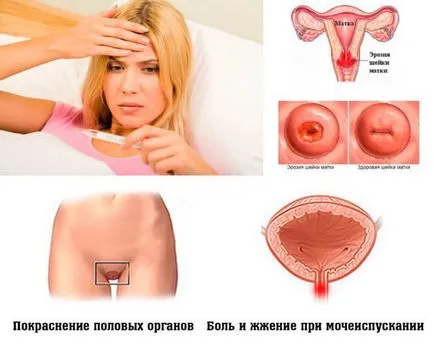 Chlamydia в женските симптоми и лечение