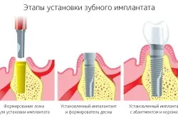 Ускладнення імплантації зубів (перший по зубах) Ускладнення імплантації зубів