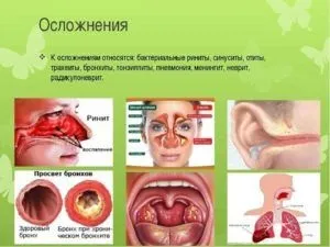 Ускладнення нежиті у дорослих (ускладнень після нежиті) Ускладнення нежиті у дорослих