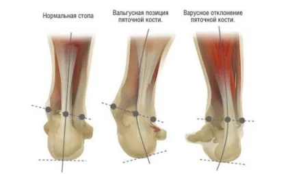Ортопедичне взуття для дітей і жінок при вальгусной деформації та встановлення стоп (взуття) Ортопедичне взуття для дітей і жінок при вальгусной деформації та встановлення стоп