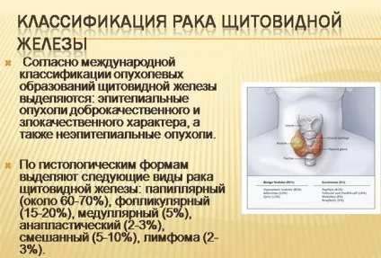 Пухлина щитовидної залози причини, симптоми, стадії хвороби і лікування (залози) Пухлина щитовидної залози причини, симптоми, стадії хвороби і лікування