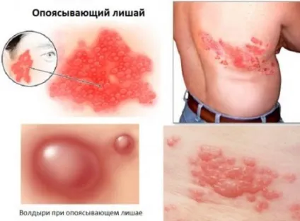 Оперізуючий лишай симптоми і лікування у дорослих 1