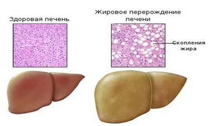 Hepatică steatoza - tratament, simptome, dieta si nutritie