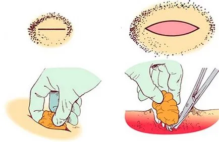 Wen atheroma és Lipoma, különbségek, okai, kezelése