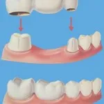 Fogászati ​​híd és típusú hidak