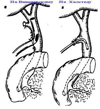 1) cu cholecystostomy drenaj extern