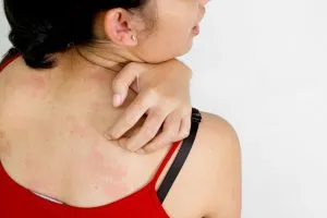 8 legjobb sampon seborrheás dermatitis a fejét