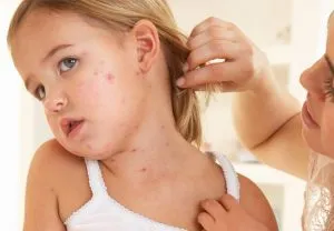 8 legjobb sampon seborrheás dermatitis a fejét