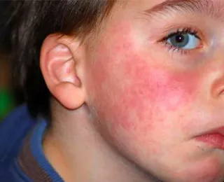 Алергии при децата симптоми и лечение