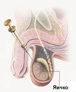 azoospermie biopsie testiculară, procedurile de executare, consecințe