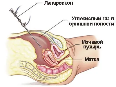 Spitalele care nu laparoscopie în hidronefroză, argumente pro și contra de laparoscopie