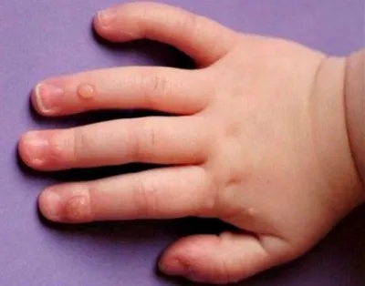 Negi pe mâinile copiilor tratați cu acasă căi de atac