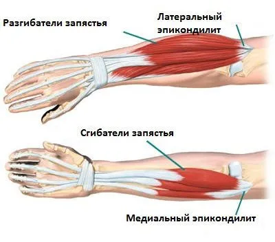 Durere la nivelul cotului cauzează artralgii severă, acută și cicălitoare