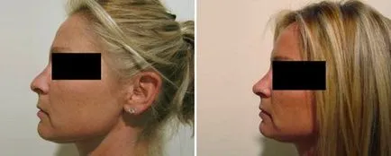 Rinoplastia non-chirurgicale, rinoplastie fara interventie chirurgicala - ce este, preturi, comentarii,