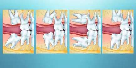 дали да премахнете мъдрец боли дъното и най-добрият избор на анестезия