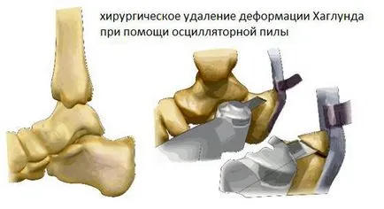 Boala shnitsa Haglund - cauze, simptome și tratament