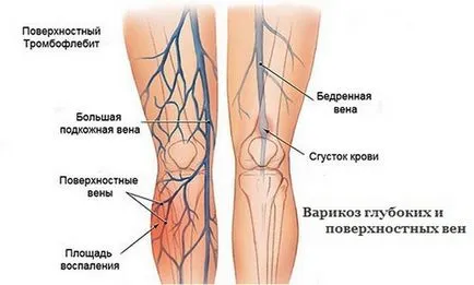 Болки в крака от коляното до подножието причинява болка в предната част, отстрани отзад