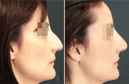 Rinoplastia non-chirurgicale, rinoplastie fara interventie chirurgicala - ce este, preturi, comentarii,