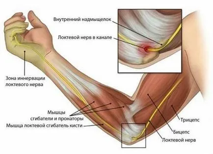 Fájdalom a könyök okoz súlyos, akut és zsémbes ízületi fájdalom