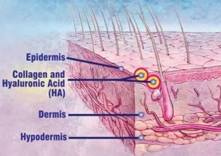 Botox или препарати на хиалуроновата киселина прилики и разлики