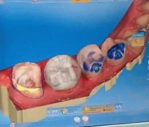 Особливості протезування зубів системою cerec, огляд з цінами (зубів) Особливості протезування зубів системою cerec, огляд з цінами