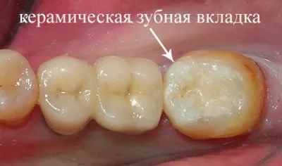 Відколовся шматочок емалі заднього зуба і дряпає мову що робити (шматочок) Відколовся шматочок емалі заднього зуба і дряпає мову що робити