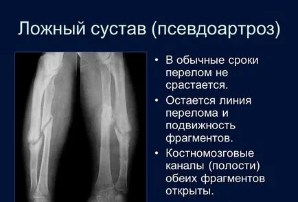 Какво е псевдоартроза (фалшива съвместни, neoarthrosis) причини, лечение, усложнения