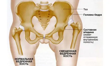 Хип дисплазия при възрастни симптоми, лечение, и последствия (видео)