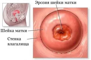Ерозія шийки матки (ерозія) Ерозія шийки матки