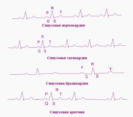 Diagnosticul electrocardiografic de aritmii cardiace