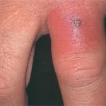 Cellulitis etiológia, patogenezis, a klinikai besorolás - Medical Journal