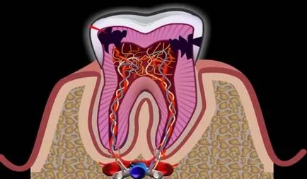 Üszkös pulpitis (krónikus)